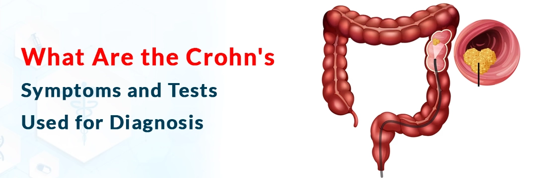 What Are the Crohn's Symptoms and Tests Used for Diagnosis